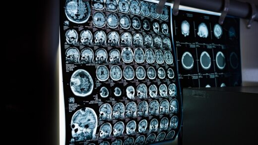 Два роки невідомої хвороби: у жінки діагностували пухлину мозку